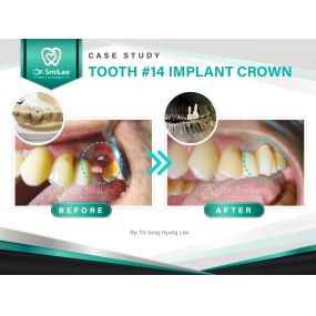 Case Study: Tooth #14 Implant Crown