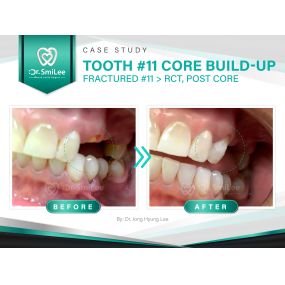 Case Study: Tooth #11 Core build-up