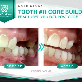 Case Study: Tooth #11 Core build-up