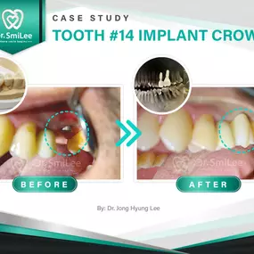 Case Study: Tooth #14 Implant Crown