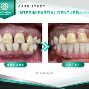 Case Study: Interim partial denture (flipper)