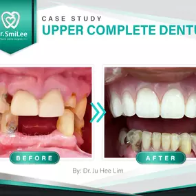 Case Study: Upper Complete Denture