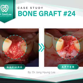 Case Study: Bone graft #24