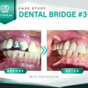 Case Study: Dental Bridge Tooth #3- 8
