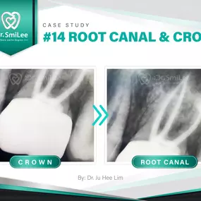 Case Study: #14 RCT and Crown