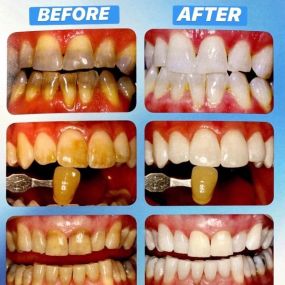 At Brighter Day Dental, we can help you feel confident in your smile!