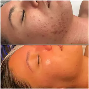 Before and after Definition of trusting the process ????
DMK does it again! Thinking about getting a DMK facial?