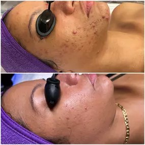 Before and after DMK can treat more skin conditions than I have socks in my drawer. And trust me, that's a lot. ????
DMK enzyme treatment can treat a variety of skin conditions, including acne, rosacea, hyperpigmentation, aging skin, sun damage, scarring, and uneven skin texture.