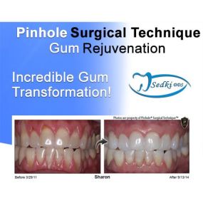 Pinhole Surgical Technique and Gum Rejuvenation