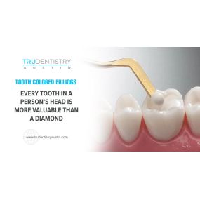 Tooth Colored Fillings - TRU Dentistry Austin (Dentist 78704)