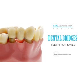 Dental Bridges - TRU Dentistry Austin (Dentist 78704)