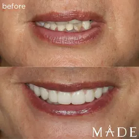 Before & After MADE Dental Implant Center treatment