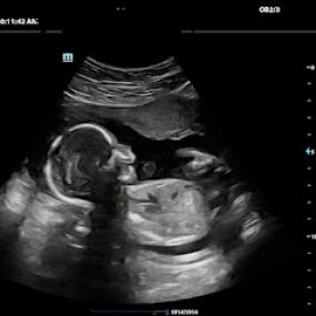 Bild von Peek a Boo Baby 3D 4D Ultrasound