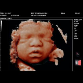 Bild von Peek a Boo Baby 3D 4D Ultrasound
