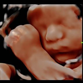 Bild von Peek a Boo Baby 3D 4D Ultrasound