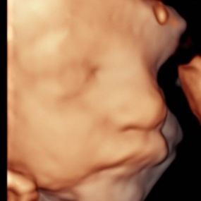 Bild von Peek a Boo Baby 3D 4D Ultrasound