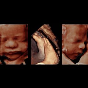 Bild von Peek a Boo Baby 3D 4D Ultrasound