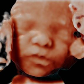 Bild von Peek a Boo Baby 3D 4D Ultrasound