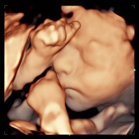 Bild von Peek a Boo Baby 3D 4D Ultrasound