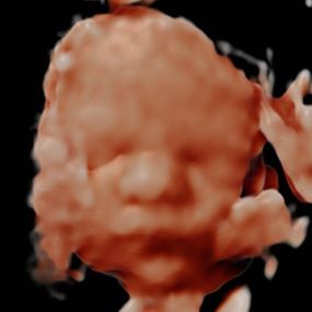 Bild von Peek a Boo Baby 3D 4D Ultrasound