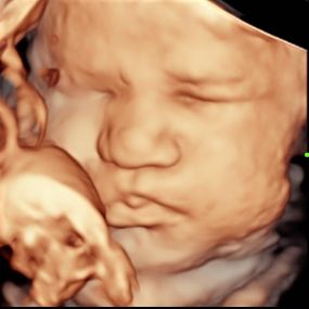 Bild von Peek a Boo Baby 3D 4D Ultrasound