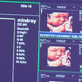 Bild von Peek a Boo Baby 3D 4D Ultrasound