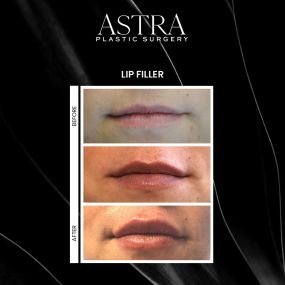 Our team of skin care experts and aestheticians offer cosmetic injectables and fillers to achieve non-surgical facial rejuvenation or as an add-on to complement other procedures. Lip fillers can enhance the appearance of the lips by adding volume to increase the size and shape of the lips for a natural-looking definition.