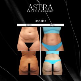 Lipo 360 is a body contouring procedure that can eliminate unwanted fat 360 degrees around the waistline to achieve a tighter, flatter midsection. Lipo 360 can be combined with other body contouring procedures, such as a Brazilian butt lift to enhance the overall results to achieve your desired figure.