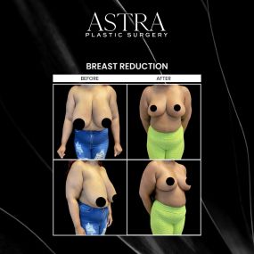 Breast enhancement surgery improves the size and shape of the breasts. At Astra Plastic Surgery, we provide cosmetic and reconstructive breast surgery, including breast implants, lift, reduction, reconstruction, areola reduction, implant removal/replacement, top surgery, and gynecomastia. Patients can expect to achieve beautifully proportionate and natural-looking breasts.