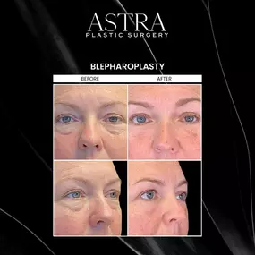 Eyelid surgery, also known as blepharoplasty, can reduce the appearance of fine lines, wrinkles, drooping eyelids, undereye bags, and other signs of aging around the upper and lower eyelids. Blepharoplasty can restore a youthful expression and brighter, more refreshed eyes.