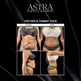 Our plastic surgery can improve the contours of the physique, helping patients achieve beautifully sculpted results. Procedures such as the tummy tuck can remove excess skin, reshape loose skin, and firm stomach muscles to accentuate contours. Following pregnancy, patients may choose to undergo a mommy makeover to address loose, sagging skin around the midsection and tighten underlying abdominal muscles. Aging, pregnancy, breastfeeding, and substantial weight loss can affect the skin, muscles, a