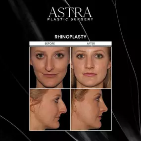 Rhinoplasty surgery reshapes the nose to improve the aesthetics of the nose and can improve breathing. The most common goals of rhinoplasty are to increase or decrease nose size, remove a nasal hump, reshape the nasal tip, and improve or correct results from a previous rhinoplasty surgery. Our facial plastic surgeons understand that nose surgery can be a life-changing procedure for many and hold themselves to the highest level of standards to meticulously reshape the nose to naturally complement