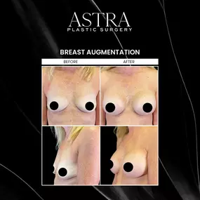 Breast augmentation can enhance the shape and size of breasts to achieve beautiful, long-lasting results. Breast implants are ideal for patients looking to increase breast size, correct asymmetrical breasts, and restore youthful contours. Breast augmentation can also address lost volume following pregnancy or breastfeeding with breast implants.