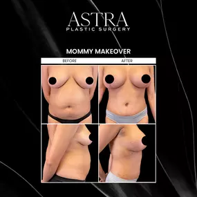 Mommy makeover surgery combines different cosmetic surgeries to restore pre-pregnancy curves and target problem areas. A fully customizable surgery, mommy makeover can address excess fat, loose skin, sagging breasts, stretch marks, and more.