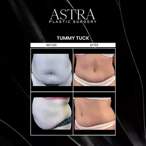 Tummy tuck surgery achieves a toned, flat midsection by addressing excess abdominal fat and loose skin. Tummy tuck is often combined with liposuction to further enhance a sculpted appearance. At Astra Plastic Surgery in Alpharetta, we offer a variety of tummy tuck techniques to choose from including a mini tummy tuck and fleur de lis tummy tuck.