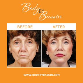 As we age, the face begins to lose volume and areas of hollowness may appear. NaturalFill® Facial Filler™ utilizes Aqualipo® technology to harvest fat cells from other areas of the body and transfer them to the face to provide rejuvenating, volumized results.