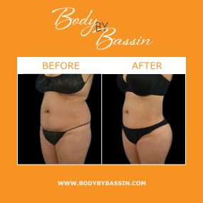 Liposuction in Melbourne offers patients maximum body-contouring results. Body By Bassin offers a variety of liposuction procedures, ranging from tradition liposuction to minimally-invasive liposuction. Liposuction options include Aqualipo®, Smartlipo®, and Lipo 360.