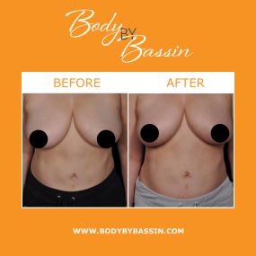 Body By Bassin in Melbourne offers breast enhancement to smooth breast irregularities, augment breast size, and enhance overall breast appearance. NaturalFill® Breast Enhancement utilizes fat transfer technology to augment the breasts.