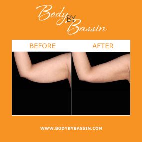 Using advanced radiofrequency technology, BodyTite™ can sculpt and tighten the skin. BodyTite™ in Melbourne can be performed on the arms, thighs, abdomen, breasts, and flanks for amazing results. The procedure is minimally-invasive and require less downtime than traditional body sculpting procedures.