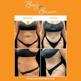 A tummy tuck can reposition and remove loose abdominal skin to restore youthful contours. A tummy tuck can be combined with liposuction procedures to achieve natural-looking results.