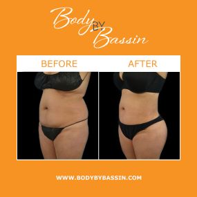 Liposuction in Melbourne offers patients maximum body-contouring results. Body By Bassin offers a variety of liposuction procedures, ranging from traditional liposuction to minimally invasive liposuction. Liposuction options include Aqualipo®, Smartlipo®, and Lipo 360.