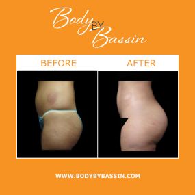 NaturalFill® Buttocks Enhancement™  is a minimally invasive buttocks enhancement option in Melbourne. By utilizing harvested fat cells from the body, NaturalFill® Buttocks Enhancement™ does not require any implants or un-natural substances to provide patients with smooth, contoured results.