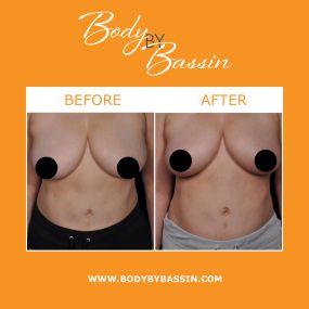 Body By Bassin in Melbourne offers breast enhancement to smooth breast irregularities, augment breast size, and enhance overall breast appearance. Minimally invasive technology now allows patients to achieve their desired results without the downtime. From radio frequency technology to natural breast transfer, patients can achieve their desired breast shape and size.