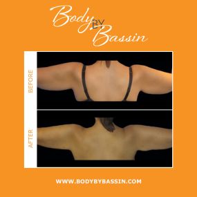 Using advanced radiofrequency technology, BodyTite™ can sculpt and tighten the skin. BodyTite™ is performed on the arms, thighs, abdomen, breasts, and flanks for amazing results. The procedure is minimally invasive and requires less downtime than traditional body sculpting procedures.