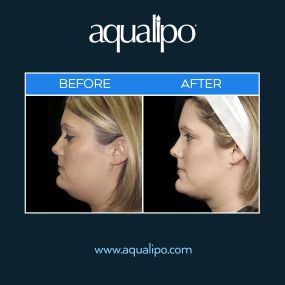 Aqualipo® Orlando provides chin & jawline liposuction for patients looking to achieve a more sculpted and defined jawline. Aqualipo® gently removes fat cells that may be causing the appearance of a double chin. The procedure is minimally invasive and the results are long-lasting.