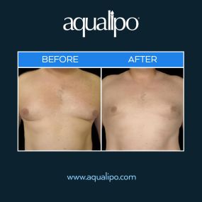 Male breast liposuction in Orlando provides a minimally-invasive solution to remove unwanted fat and sculpt the chest. Our doctors specialize in liposuction for patients suffering from gynecomastia, or enlarged male breasts. This procedure uses Aqualipo®  to provide patients ideal results while requiring minimal downtime.