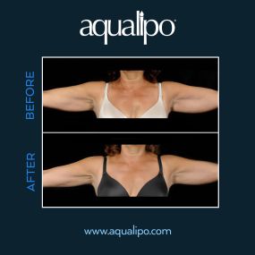 Arm liposuction in Orlando is effective in removing excess fat that often hangs below the bicep. Aqualipo® water liposuction is successful in treating this area and providing patients with scar-free results that are long-lasting. Aqualipo® can achieve slender, toned looking arms without the need for invasive surgery.