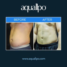 SmartLipo™ in Orlando is uses ground-breaking laser technology to melt away fat and tighten skin in one procedure! SmartLipo™ is effective in melting away fat cells without harming the surrounding tissue. SmartLipo™ can achieve long-lasting results while causing less bleeding, bruising, and swelling than traditional liposuction.