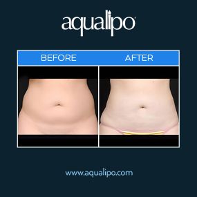 Aqualipo® in Orlando is effective in ridding patients of unwanted fat that won’t go away no matter how much you diet and exercise. Aqualipo® is a minimally invasive procedure that uses a water-assisted liposuction technique to give patients long-lasting results. Aqualipo® causes minimal bruising, swelling, and downtime. The revolutionary procedure provides results that are long-lasting.