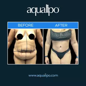 Lipo 360 in Orlando works to remove abdominal fat using a circumferential technique. Unlike traditional abdominal liposuction, Lipo 360 targets the entire waistline to create symmetrical slimming results. The Lipo 360 procedure can be personalized to fit the individual goals of each patient while requiring less downtime.